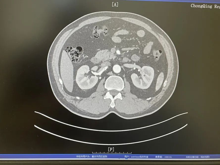 肠系膜上动脉夹层治疗成功案例,我院成功完成肾动脉狭窄介入术