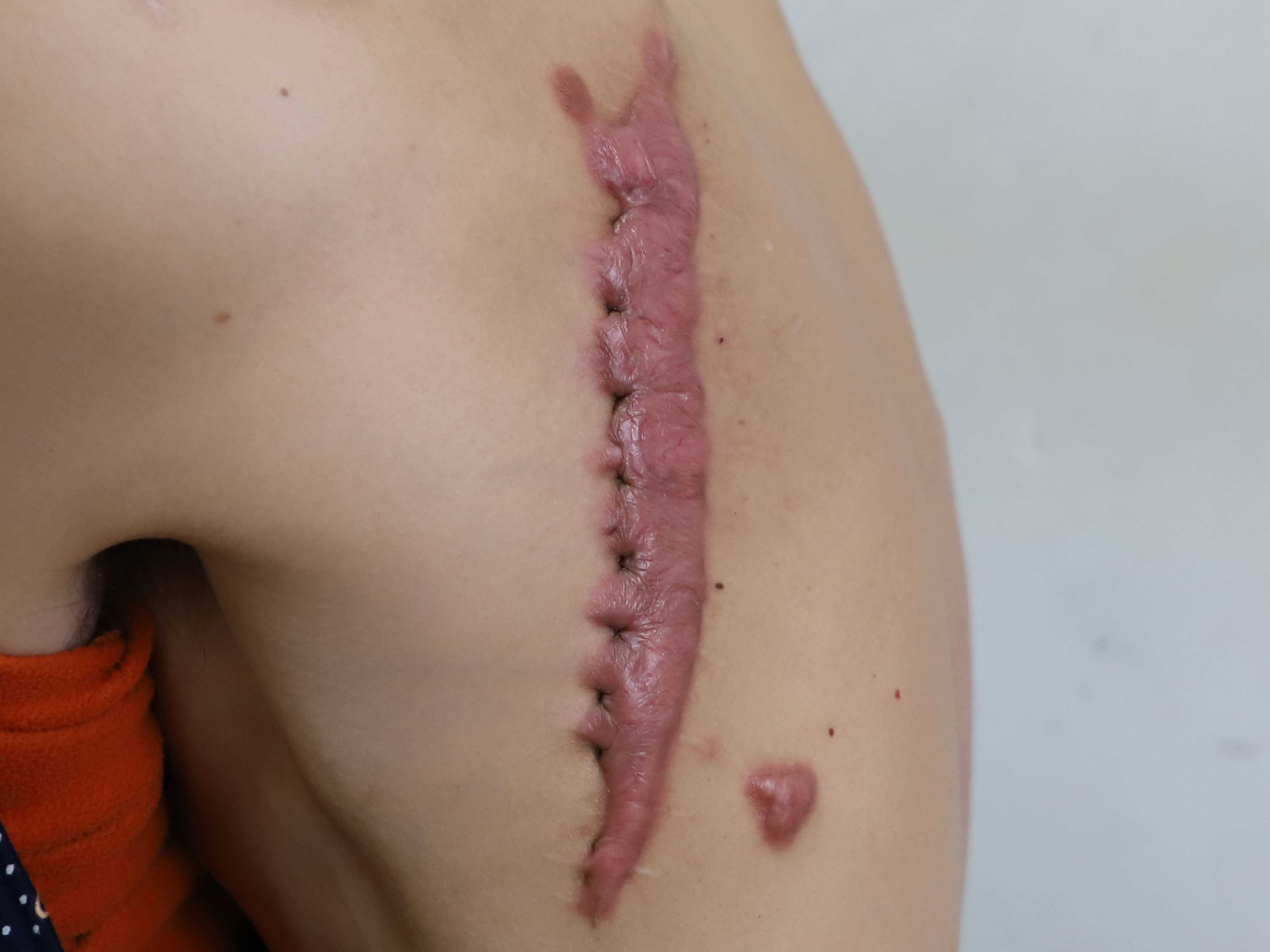 郑州市第二中医院祛疤痕,郑州二七区第二中医院治疗疤痕