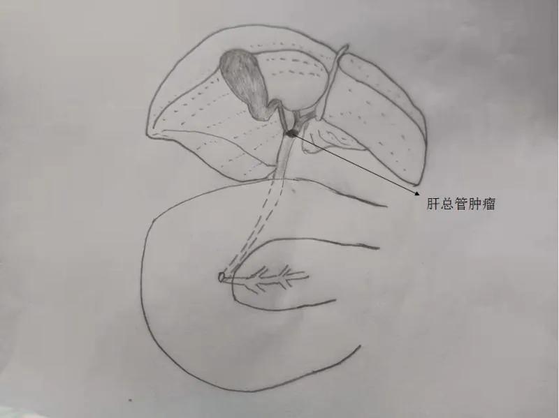 肿瘤患者尿液呈茶色,小便呈茶色尿常规正常