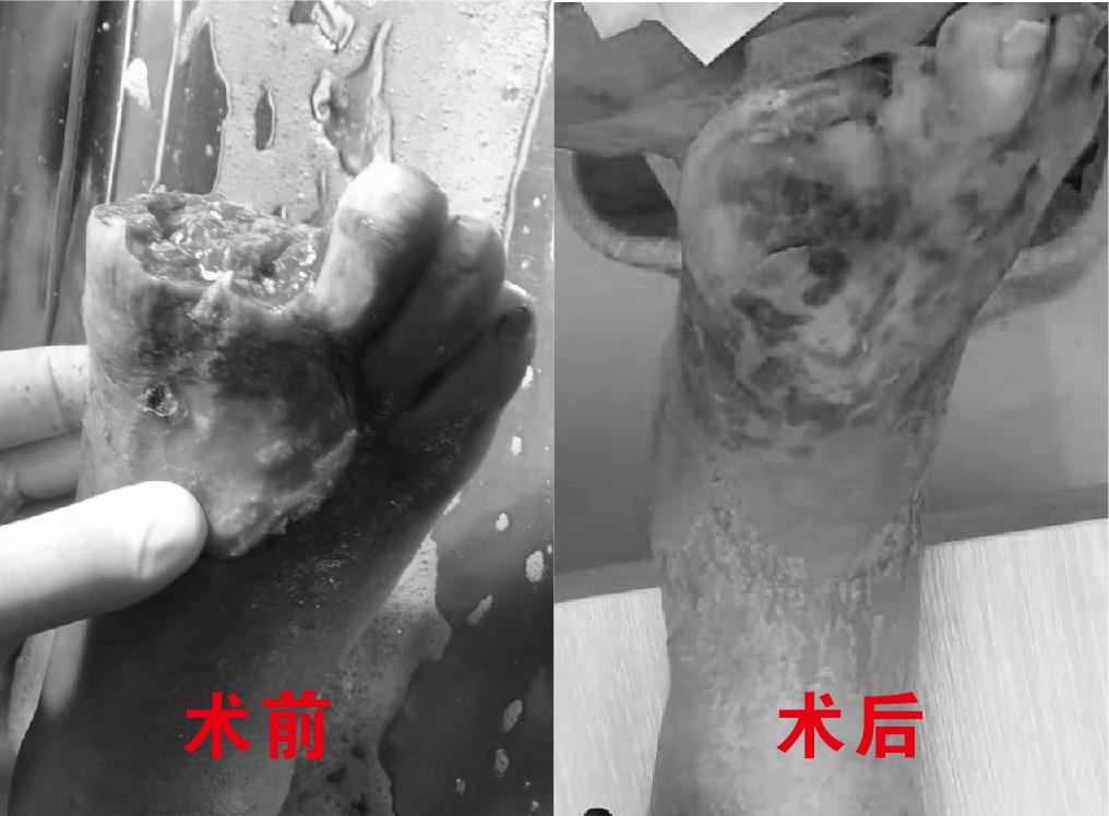 糖尿病足小发明,胫骨皮瓣移植治疗糖尿病足