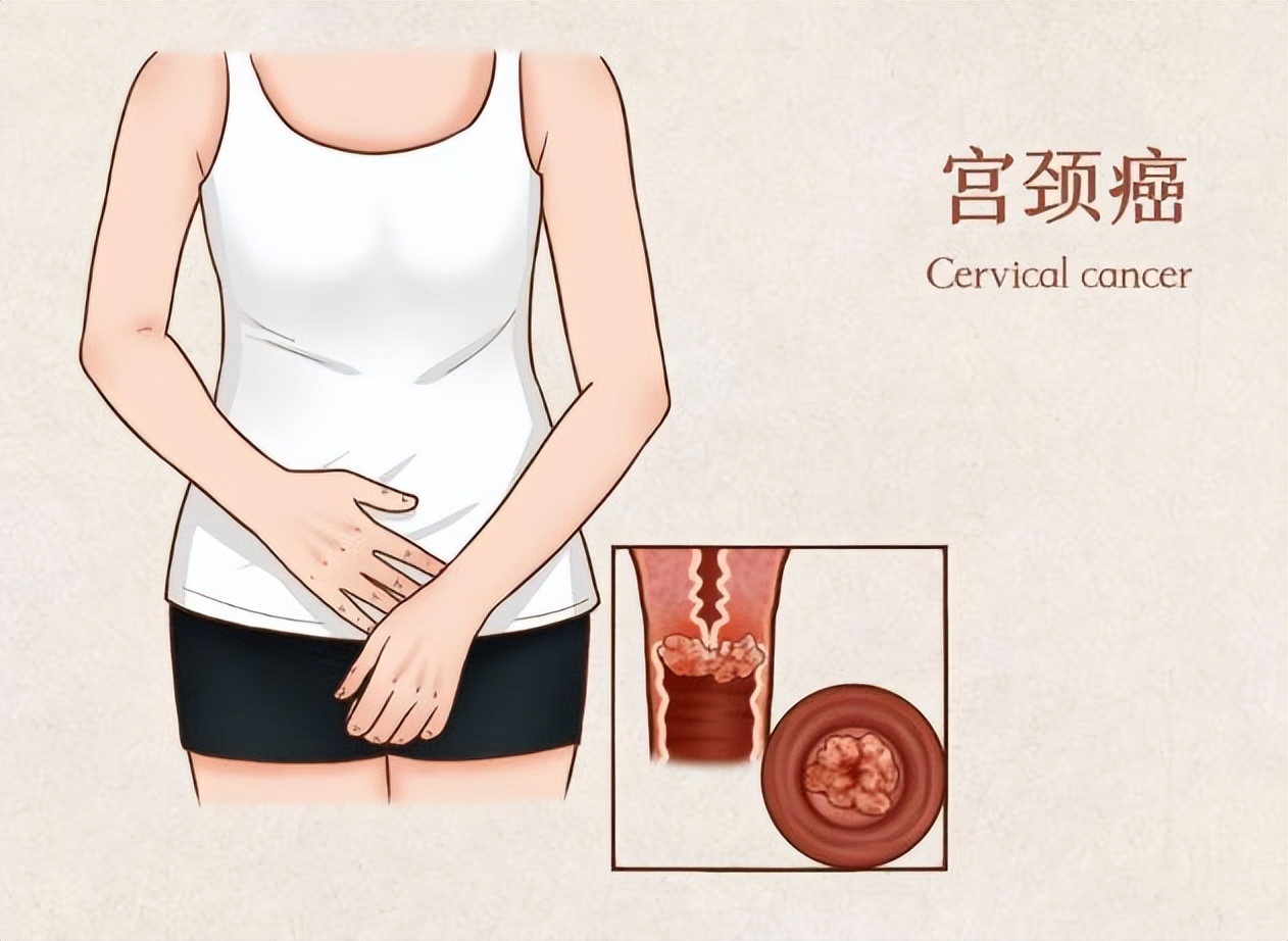 女人摘掉子宫后，和正常的女性有何不同呢？医生说出实话