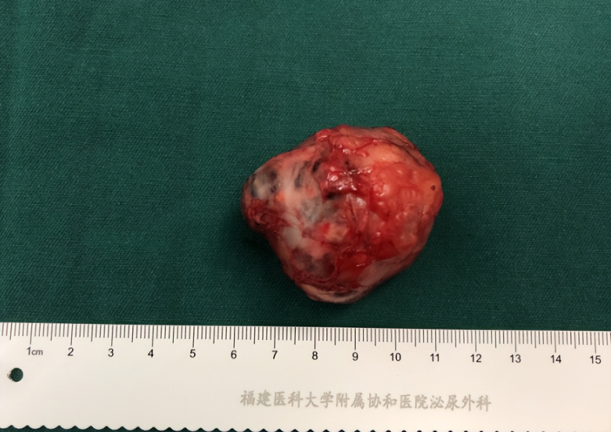 【协和医疗】高难度！泌尿外科朱绍兴教授团队高超“组合拳”完成肾肿瘤保肾手术