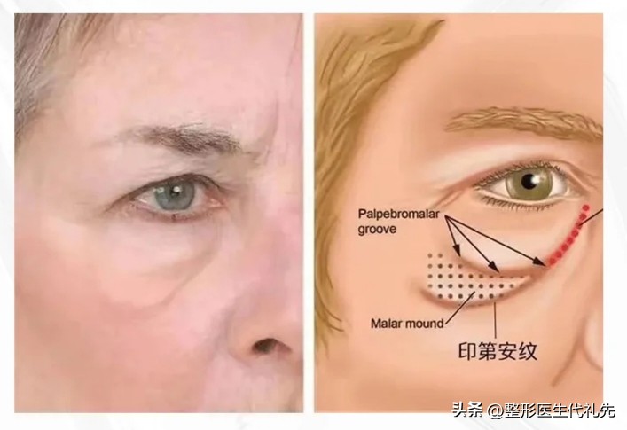 印第安纹形成的原因，印第安纹怎么去除效果最好？