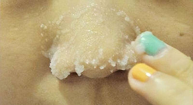 鼻子黑头感觉脏脏的,草莓黑头怎么去除最有效