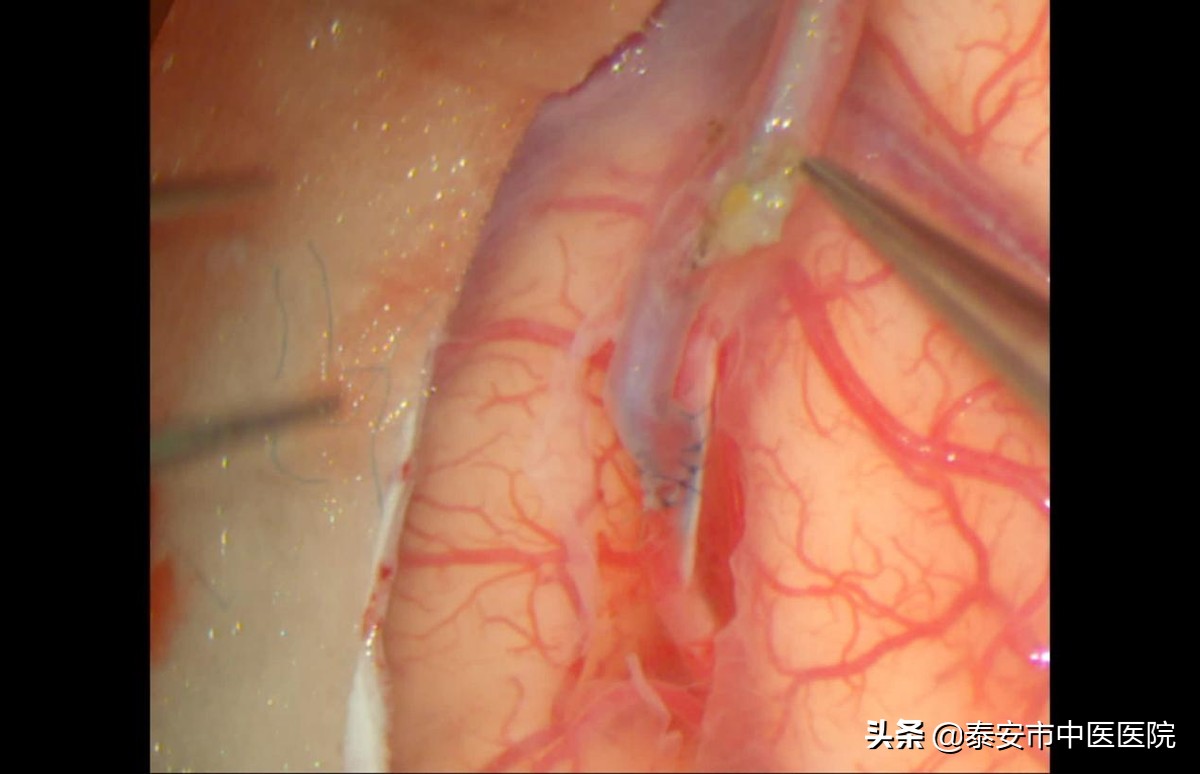 硬核技术!*安泰**市中医医院成功完成本院首例颅内外血管搭桥手术