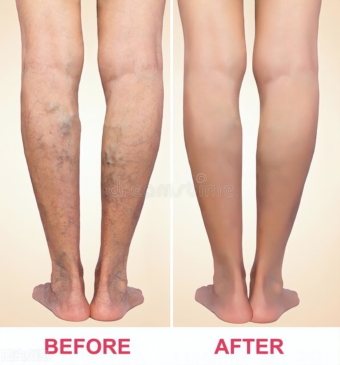 静脉曲张补什么,静脉曲张中医有中成药吗