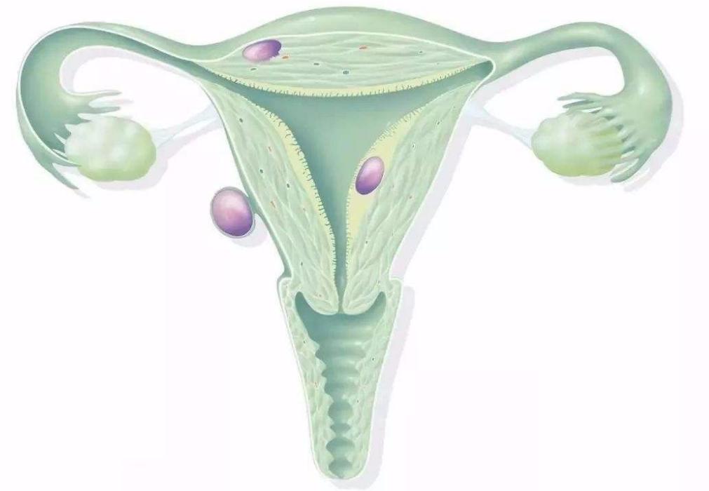 子宫肌瘤的中医治疗方法有哪些,中医治疗子宫肌瘤最好的治疗方法