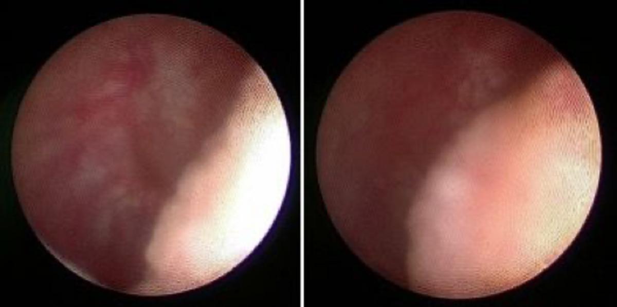 梗阻性无精症有可能排出精子吗,精囊镜治疗梗阻性无精
