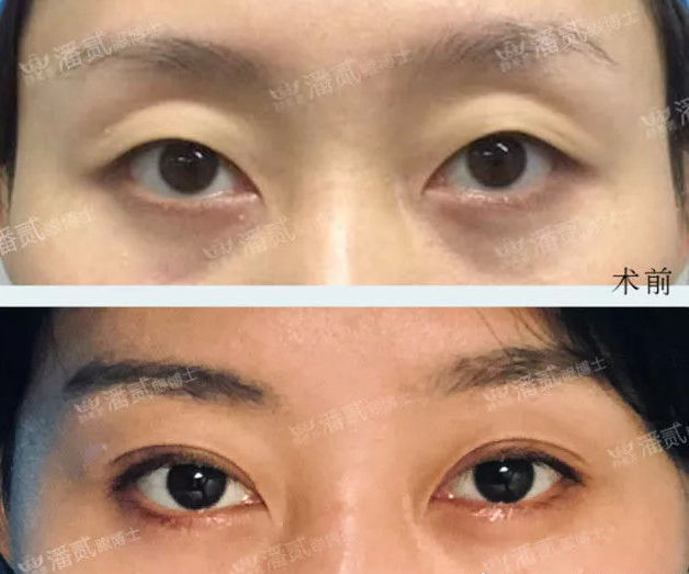 眼窝凹陷是什么症状,眼窝凹陷的改善方法有哪些