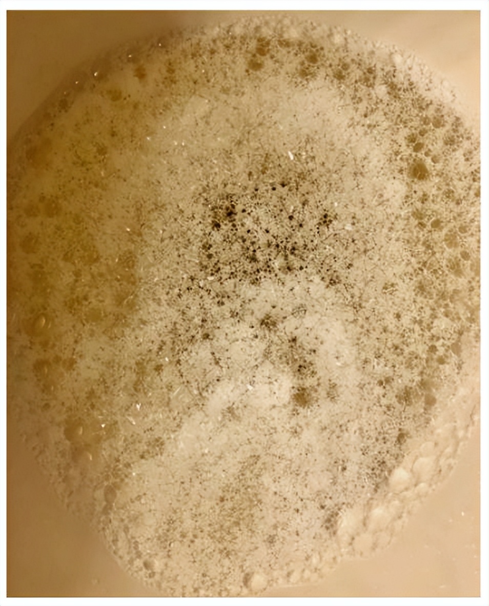 肾病综合征患者停药后要注意什么,老年人肾病综合征有哪些注意事项