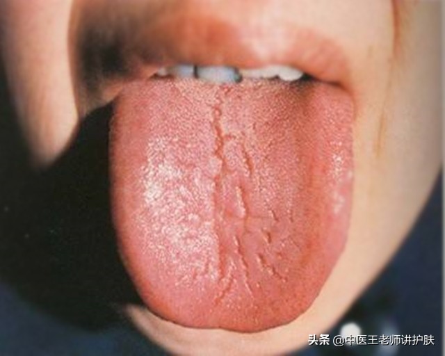 肝肾阴虚长斑怎么去掉,女人肝肾虚长斑怎么治