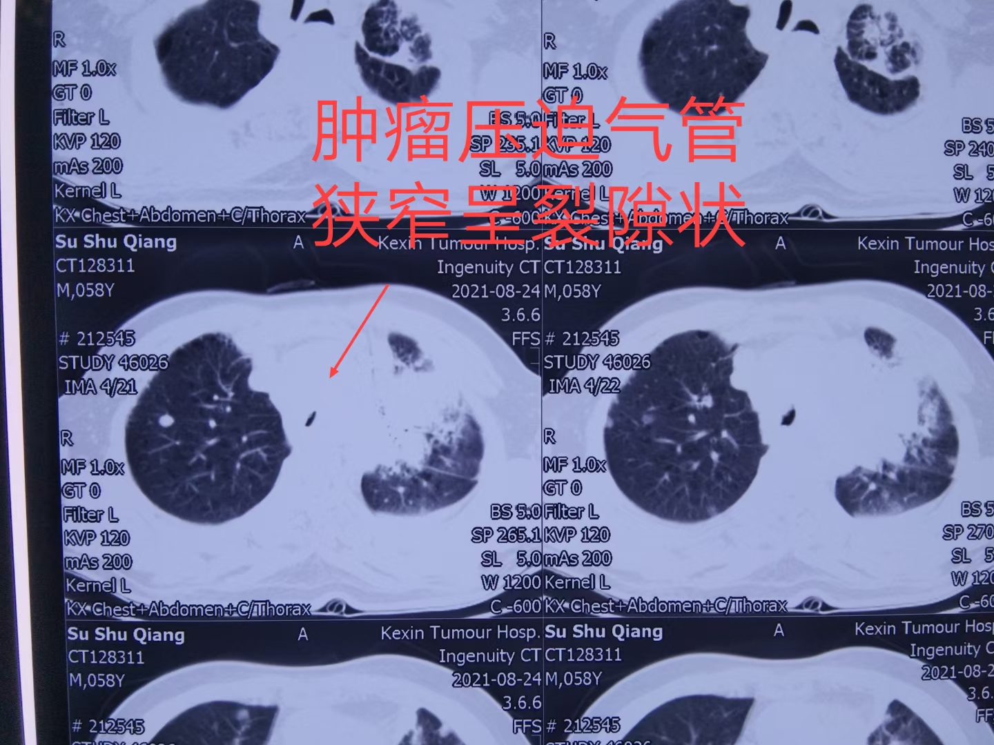 肿瘤压迫气管呼吸困难护理措施,肿瘤压迫气管呼吸困难怎么办