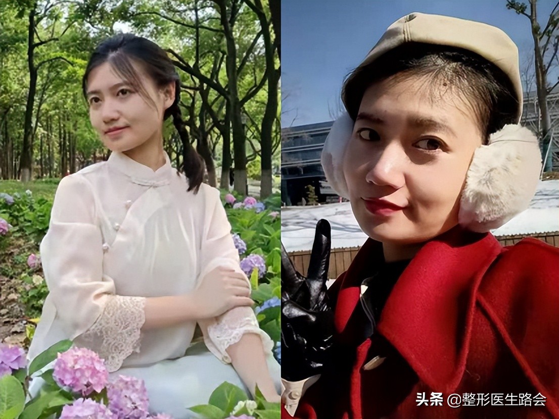 29岁眼袋黑眼圈泪沟严重怎么处理,35岁做泪沟眼袋最好的方法