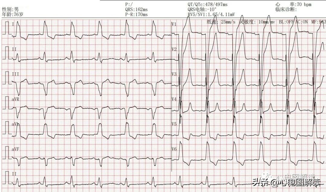 II、III、aVF导联的正常q波、异常Q波