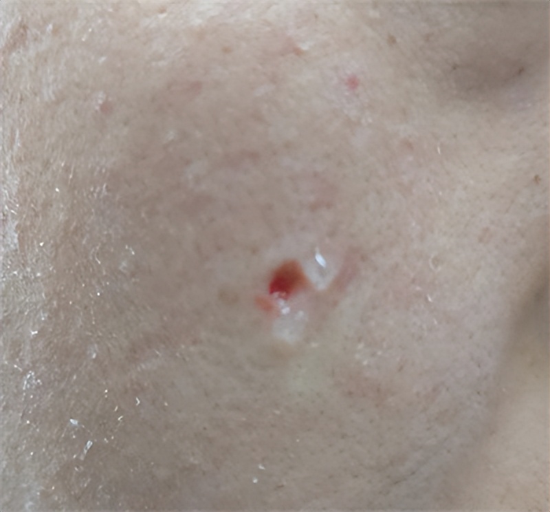 脸上的痣可以点掉吗,脸上有痣激光去痣好还是药水点好