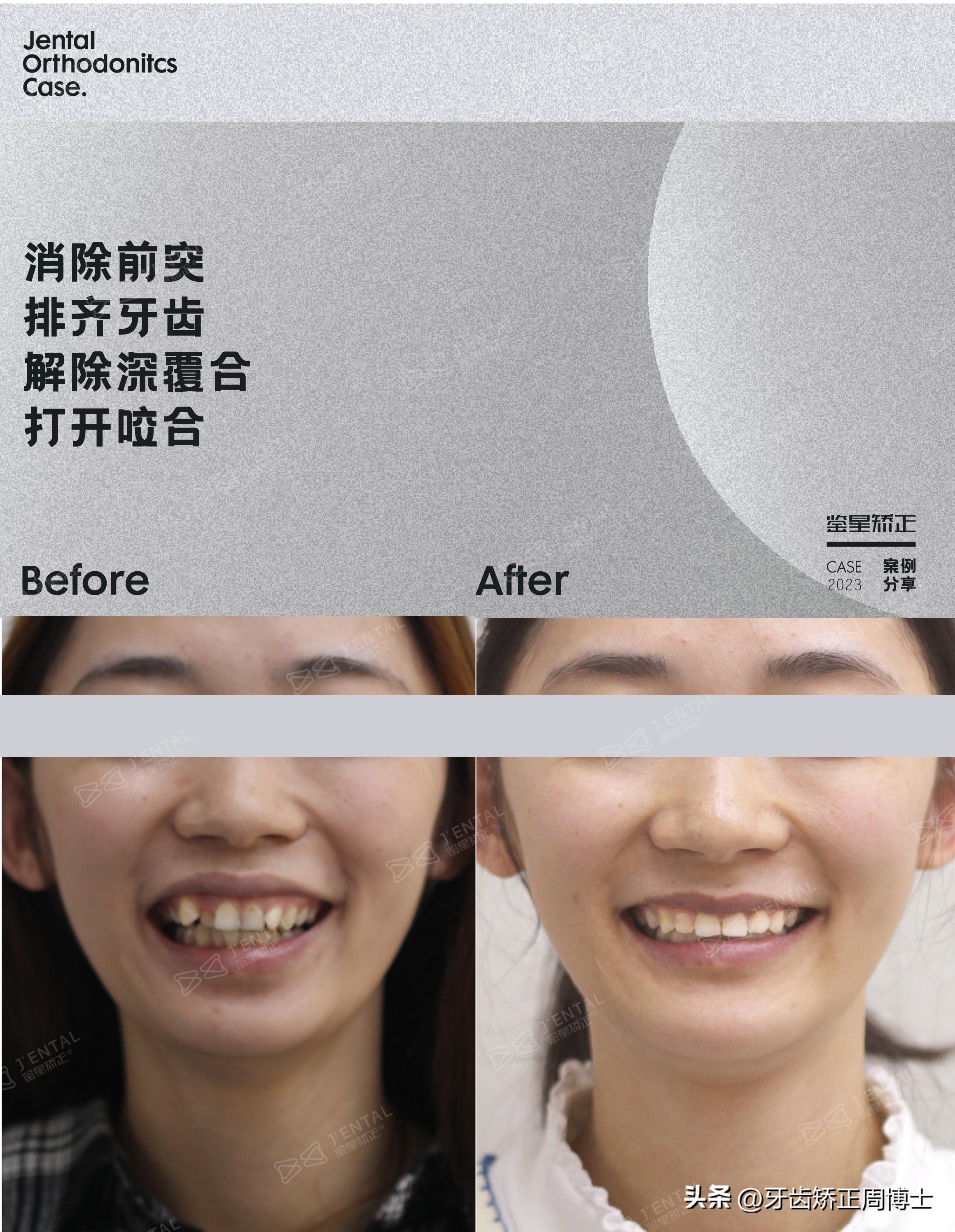 轻度拥挤龅牙咬合错位,龅牙导致牙齿咬合错位矫正价格