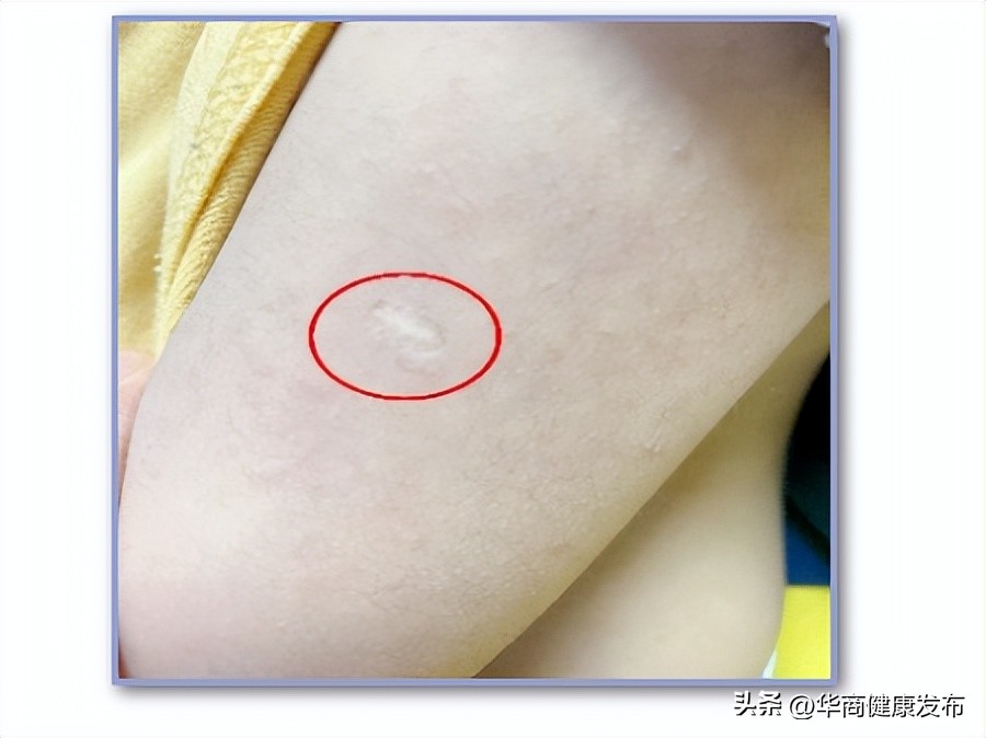 怎么知道曾经种过卡介苗,卡介苗长大后能补种吗