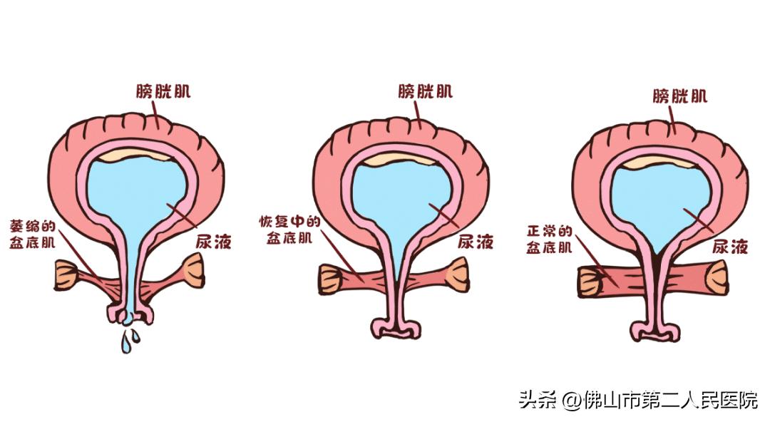 漏了，松了，还很疼？你还觉得产后康复没有必要吗？