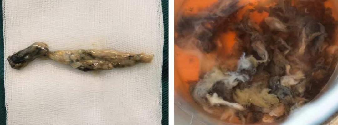 病死率和致死率,病死率20%