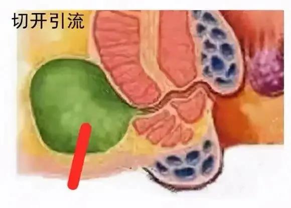 肛周脓肿肛门疼痛如何缓解,肛门一侧鼓包是痔疮还是肛周脓肿