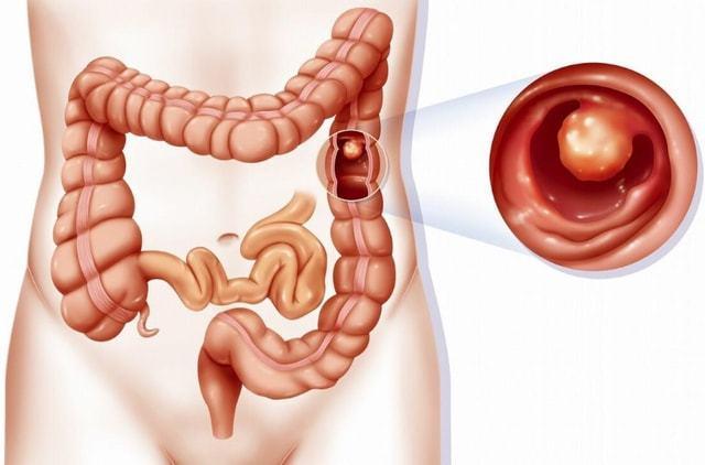 术后不放屁怎么办教你一招,手术后几天不放屁是什么原因