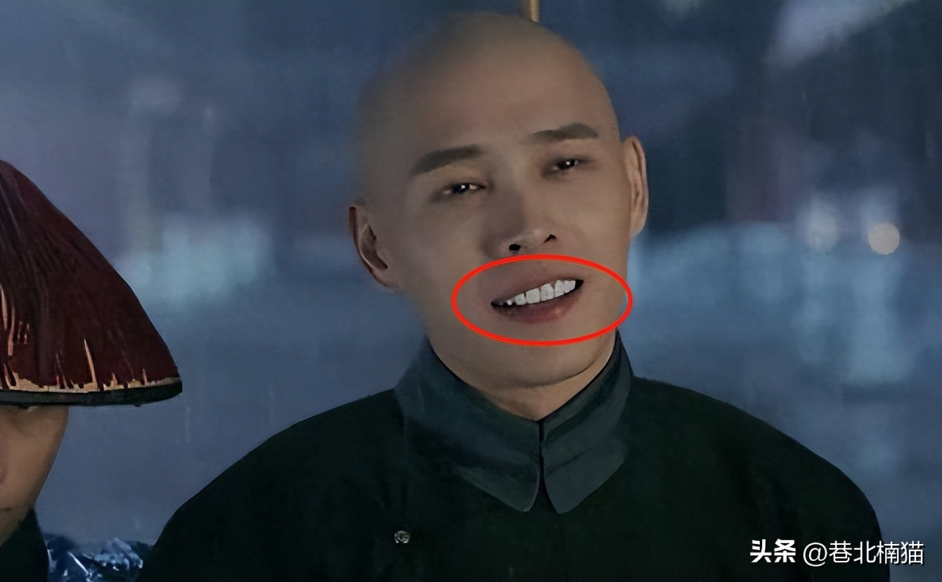 明星嘴突戴牙套前后对比,明星和假牙