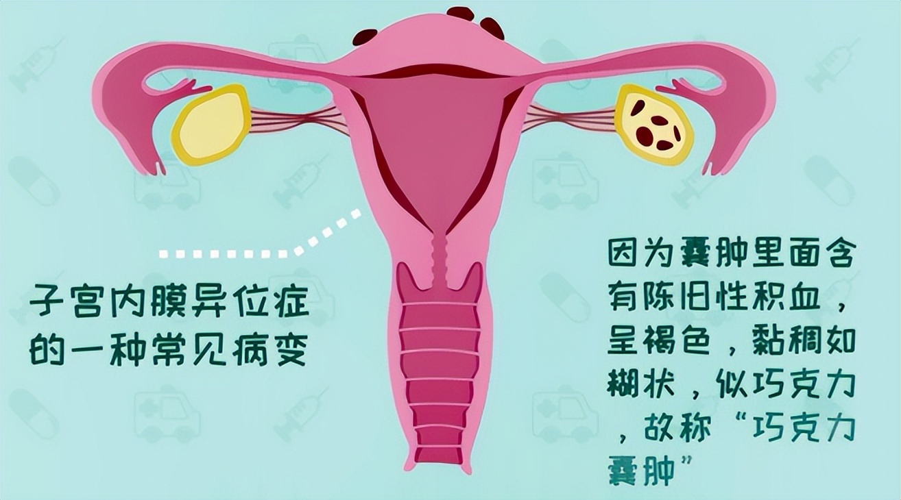 巧克力囊肿会导致哪些问题,巧克力囊肿为什么医生让尽快怀孕