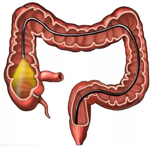 肠长了息肉有什么症状,肠里有息肉是怎么造成的