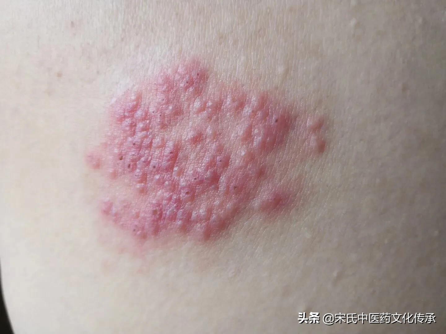 带状疱疹病例中医诊断,中医刺血预防带状疱疹