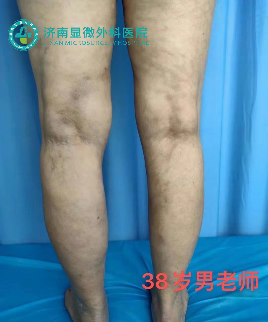 静脉曲张中医专家怎么治,静脉曲张郑州杨医生