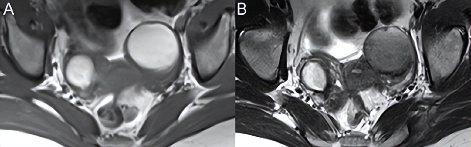 卵巢良性病变mri诊断思路,核磁共振可以看出卵巢病变吗