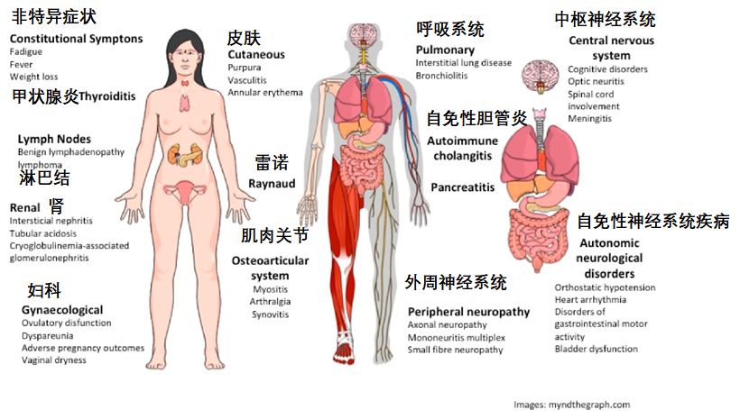 干燥综合症，啥表现？怎么治？谢医生一文说清楚！「干燥综合征」