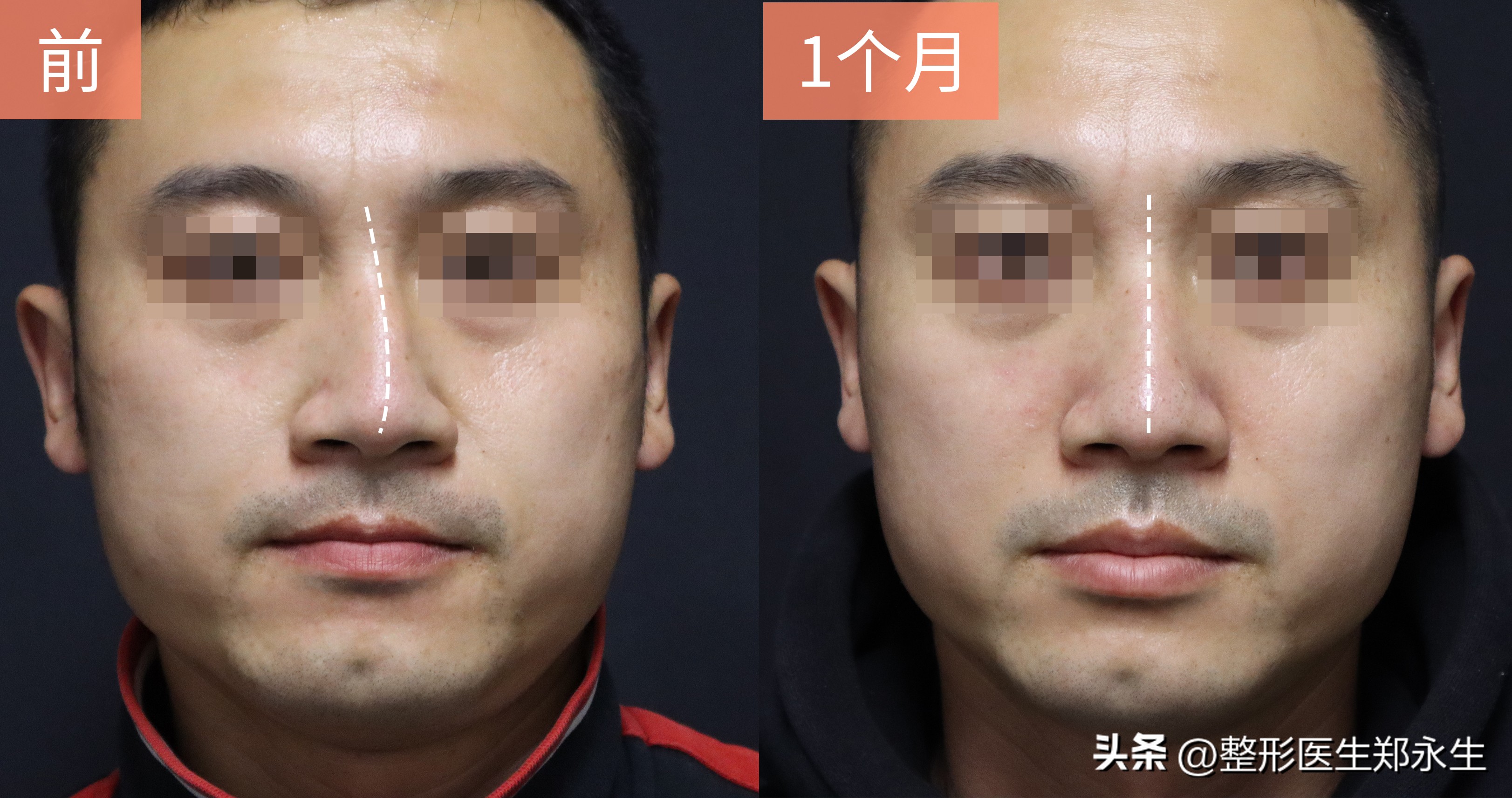 鼻子歪了怎么矫正,鼻子歪了矫正后呼吸会好吗