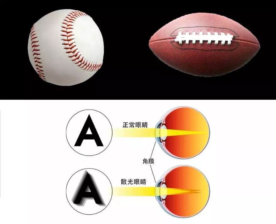 关于散光的详细科普,散光科普小视频