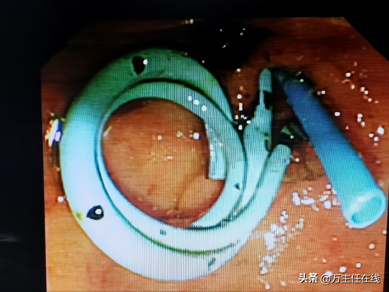 胆结石化脓性胆囊炎,妙手神针巧治疑难杂症