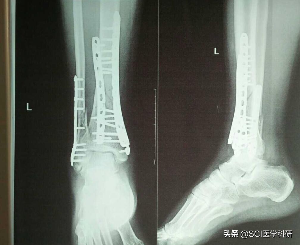 孩子不小心骨折,孩子不小心摔伤了怎么安慰孩子