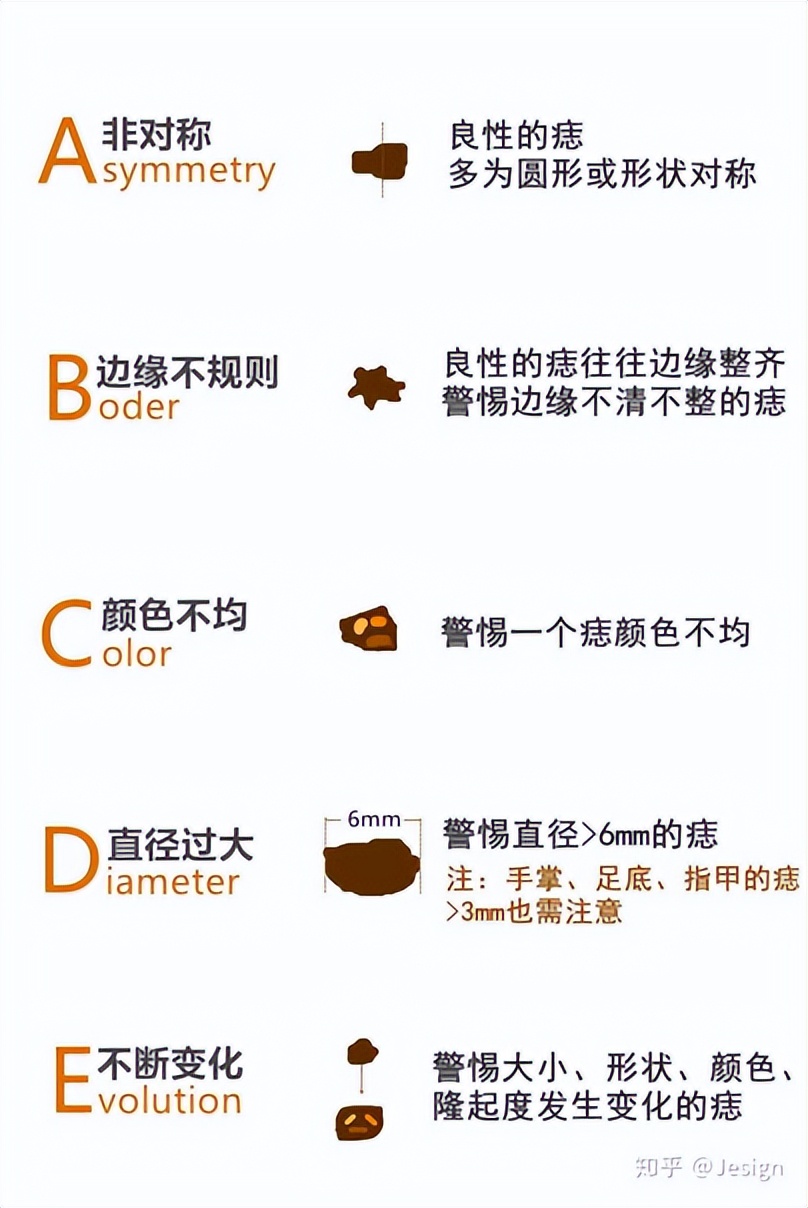 谈痣色变,身上长的痣都是色素痣吗