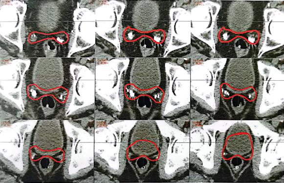 前列腺癌放疗部位,晚期前列腺放疗靶区