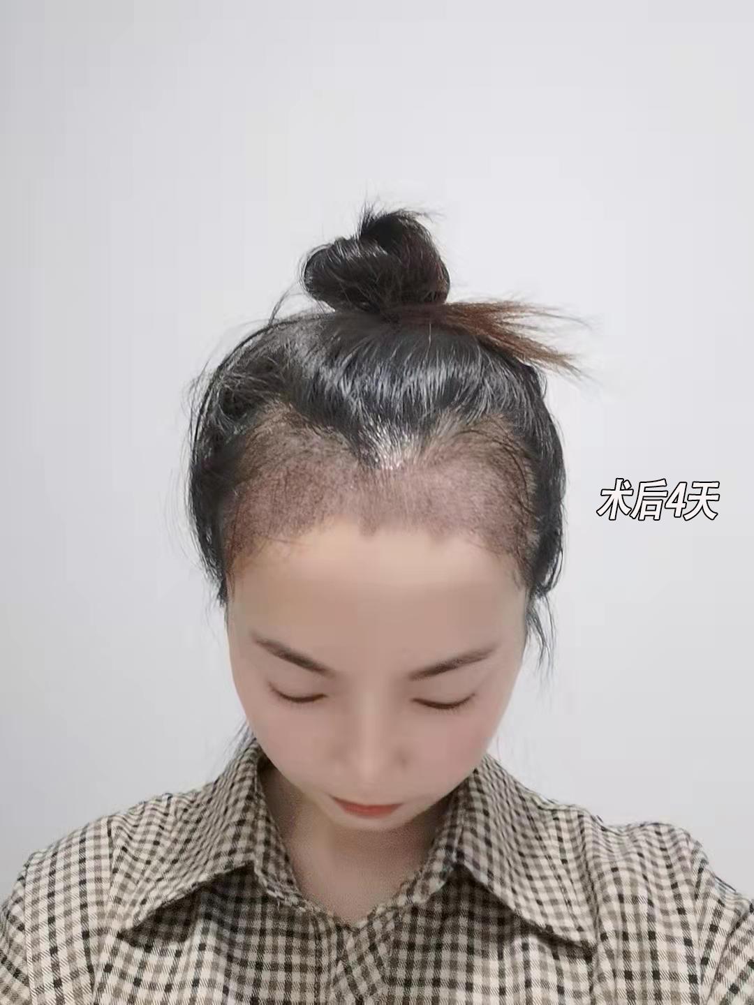 恒美植发需要多少钱,恒美植发跟碧莲盛植发