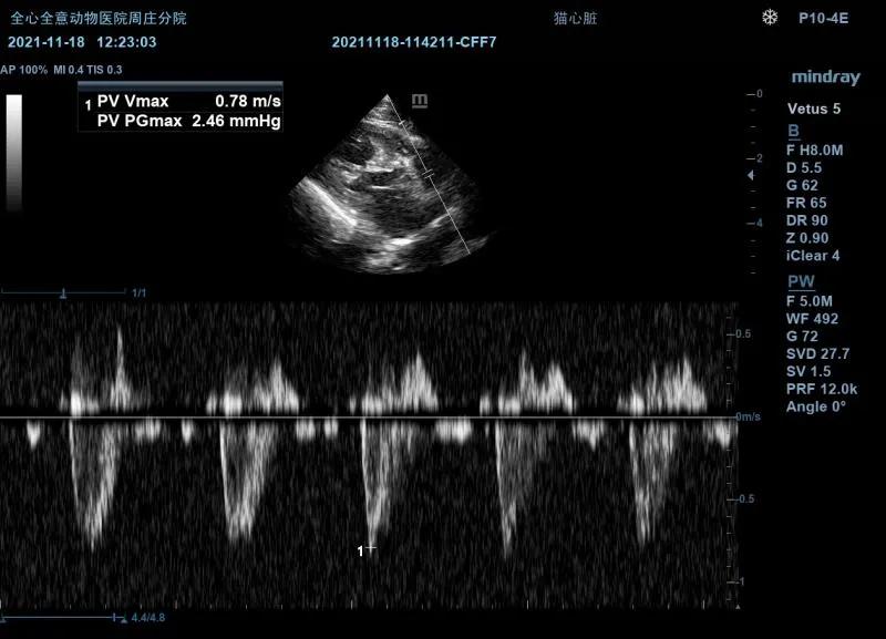 二尖瓣发育不良病例总结