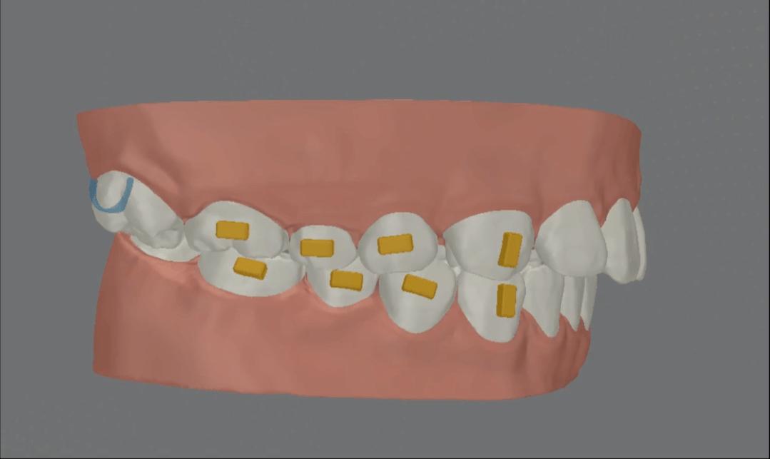无托槽隐形矫治流程,隐形矫正早期干预