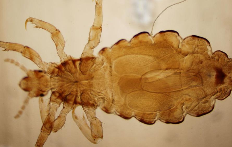 母女俩下腹瘙痒，医生用镊子夹出阴虱！原来阴虱有这4个传播途径