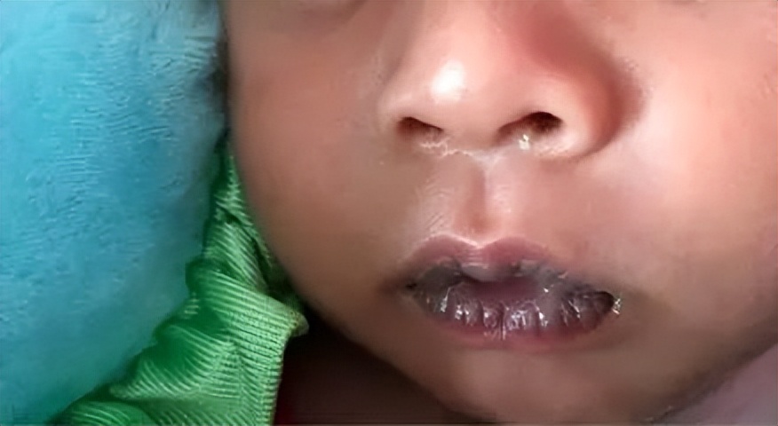 宝宝嘴唇发紫是什么病的预兆,宝宝嘴唇发紫是什么原因该怎么办