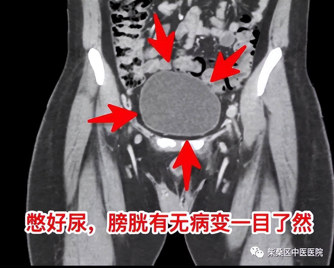做ct喝水憋尿要多久,喝水憋尿做的尿常规准确吗