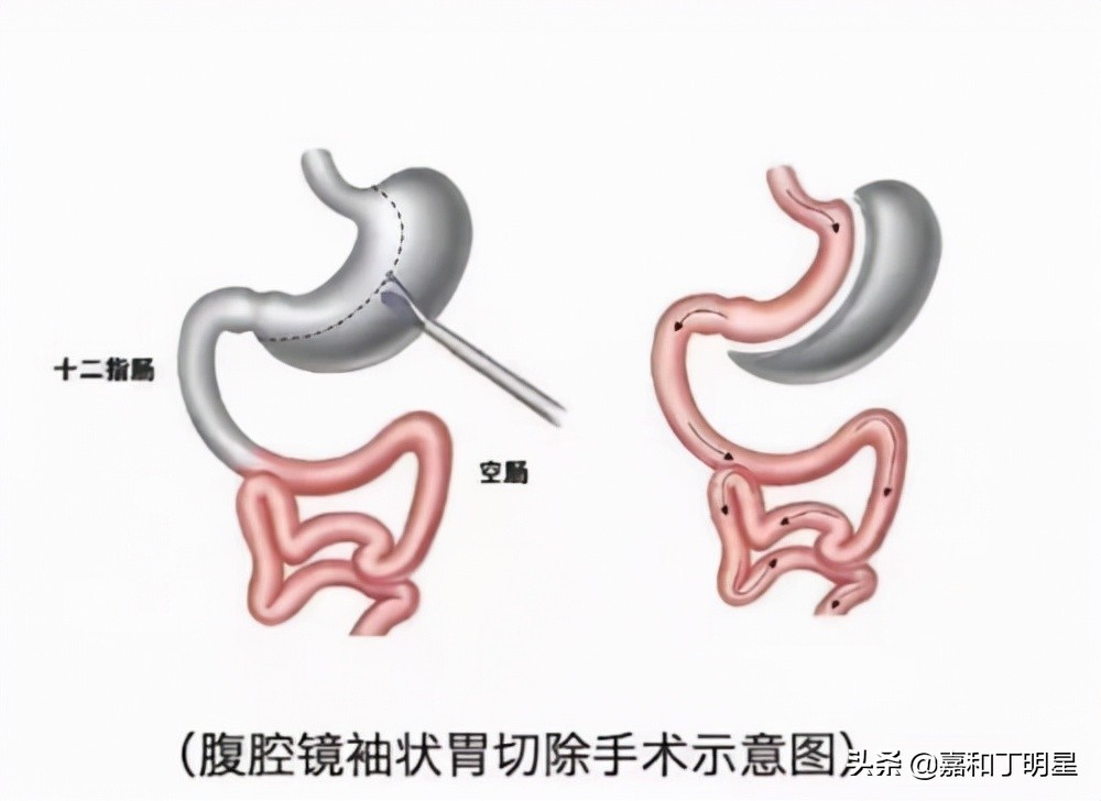 长春嘉和外科医院减重手术多少钱,吉林长春嘉和医院手术费用