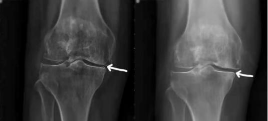 prp治疗膝关节退行性关节炎,骨性膝关节炎注射prp有效果吗