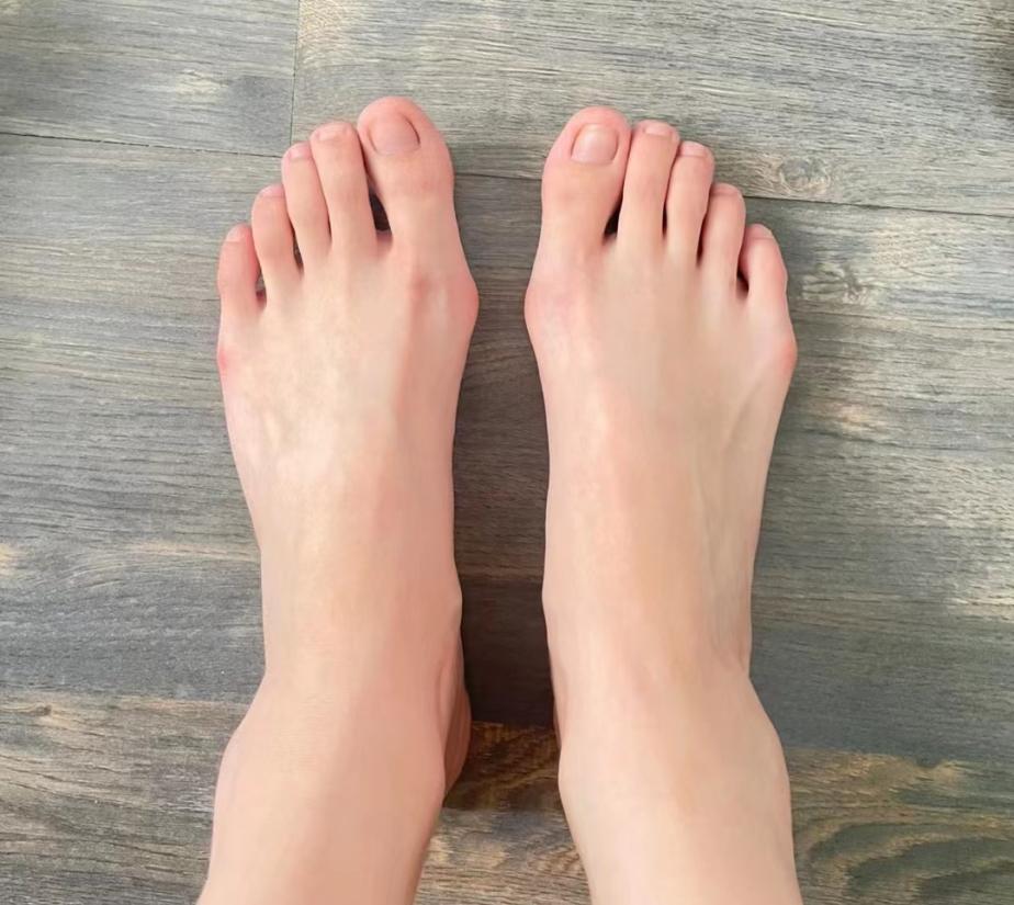 脚趾外翻疼痛怎么治,脚趾外翻肿痛怎么消肿