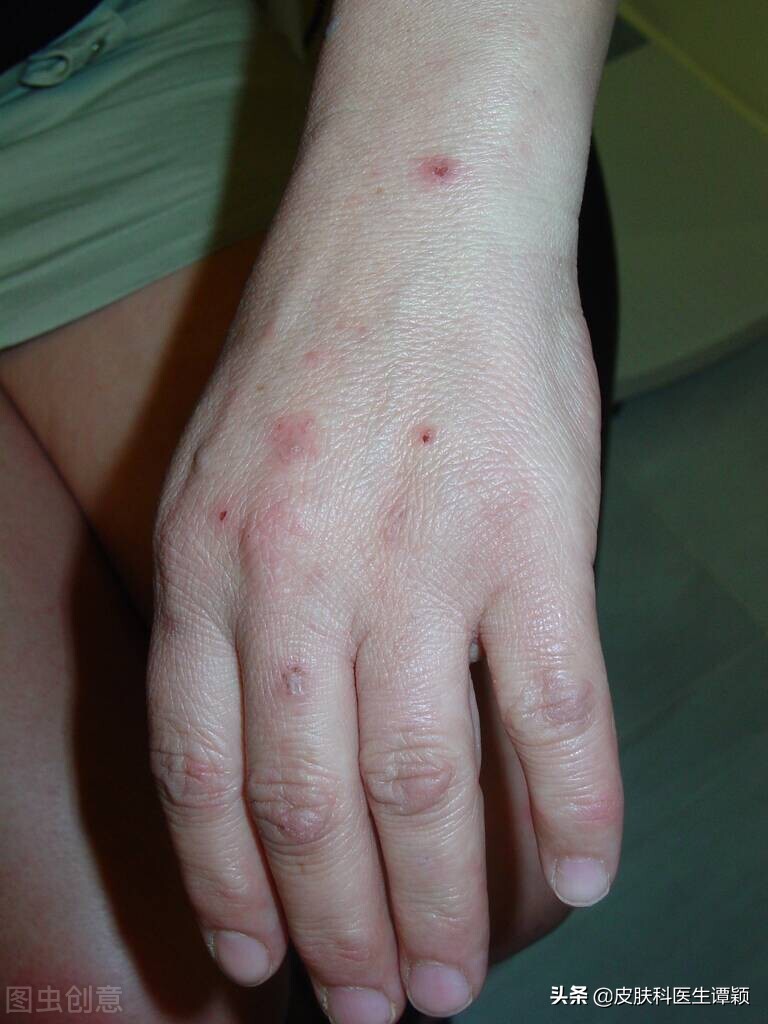 皮肤科医生和你聊聊：初夏季节，如何防治“丘疹性*麻疹荨**”？