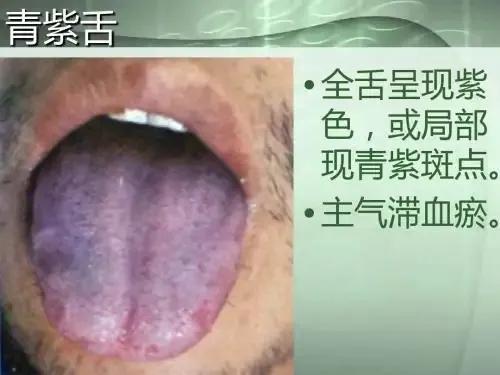 舌下部青紫中医怎么判断,中医看舌下淤血是什么原因