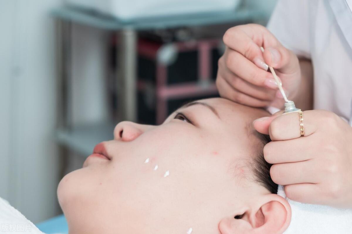 16岁儿童脸上长疮怎么办,16岁长痤疮怎么办